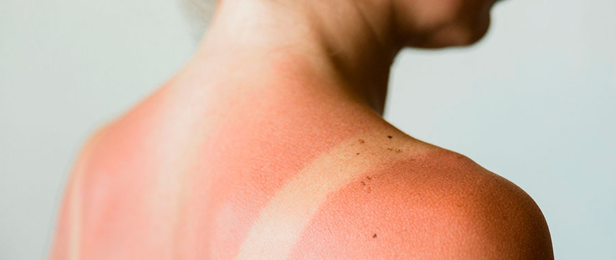 sunburned skin home remedies